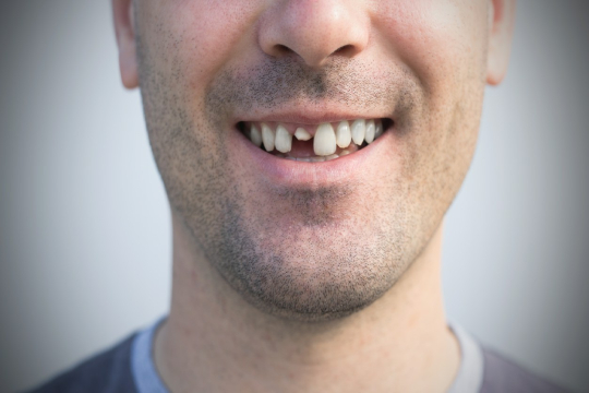 mężczyzna ze złamanym zębem