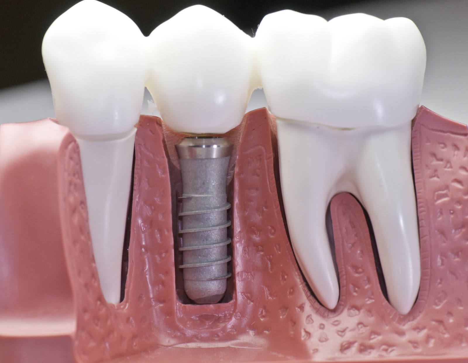 zębowe implanty
