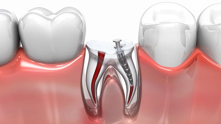 wkłady korzeniowo-zębowe 3