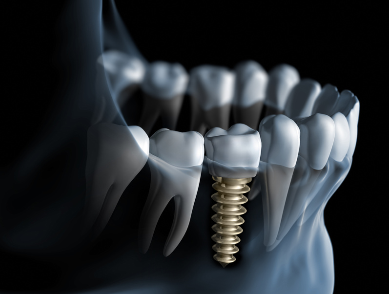 implant zęba metalowy