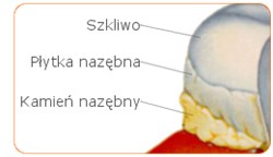 kamień nazębny